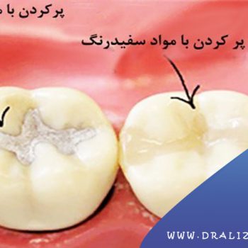 بهترین مرکز کامپوزیت در تهران | لمینت دندان در تهران