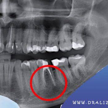 کشیدن ریشه دندان بدون جراحی