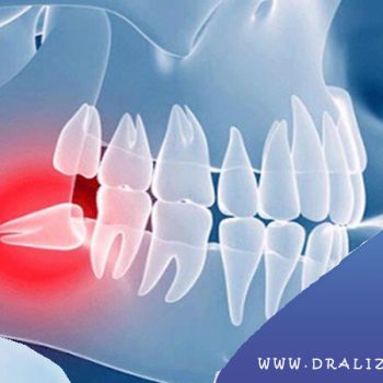 کشیدن دندان عقل نیمه نهفته